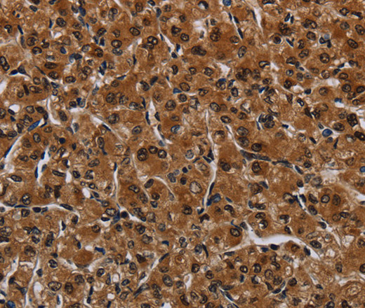 Immunohistochemistry of paraffin-embedded Human prostate cancer using IRGM Polyclonal Antibody at dilution of 1:60