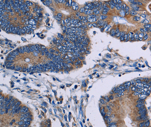 Immunohistochemistry of paraffin-embedded Human colon cancer tissue using ITK Polyclonal Antibody at dilution 1:50