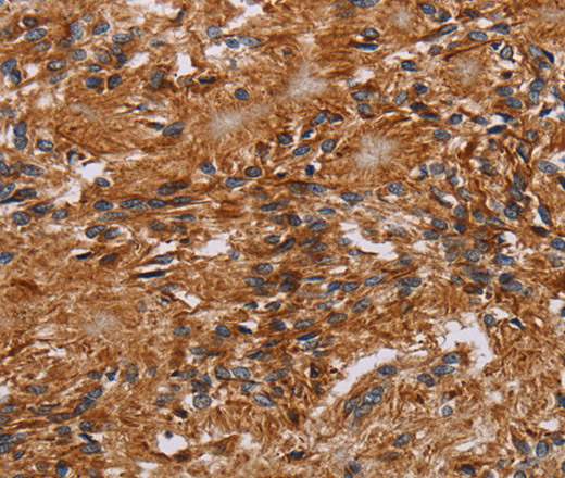 Immunohistochemistry of paraffin-embedded Human ovarian cancer tissue using JAKMIP2 Polyclonal Antibody at dilution 1:40