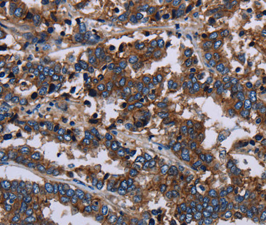 Immunohistochemistry of paraffin-embedded Human liver cancer using JAM-A Polyclonal Antibody at dilution of 1:60