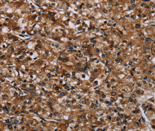 Immunohistochemistry of paraffin-embedded Human prostate cancer tissue using KDM3B Polyclonal Antibody at dilution 1:50