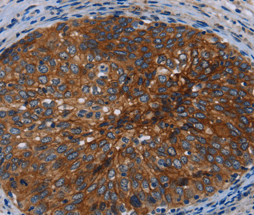 Immunohistochemistry of paraffin-embedded Human cervical cancer using Catenin gamma Polyclonal Antibody at dilution of 1:50