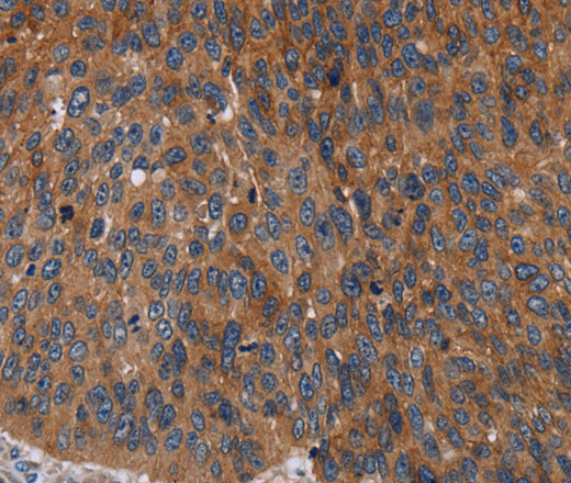 Immunohistochemistry of paraffin-embedded Human lung cancer using Catenin gamma Polyclonal Antibody at dilution of 1:50