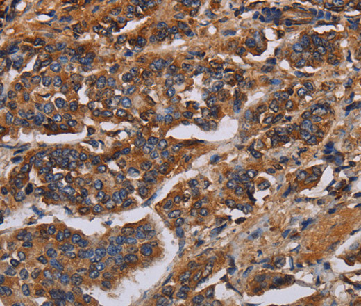 Immunohistochemistry of paraffin-embedded Human breast cancer using KCNQ1 Polyclonal Antibody at dilution of 1:50