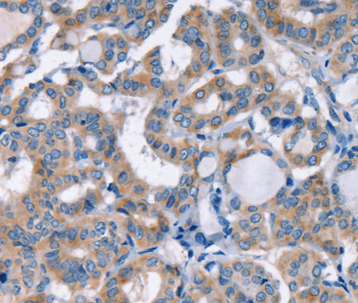 Immunohistochemistry of paraffin-embedded Human thyroid cancer using KCNQ5 Polyclonal Antibody at dilution of 1:30