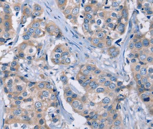 Immunohistochemistry of paraffin-embedded Human breast cancer using KCNQ5 Polyclonal Antibody at dilution of 1:30