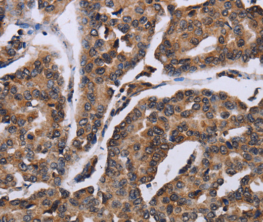 Immunohistochemistry of paraffin-embedded Human breast cancer using KIF1C Polyclonal Antibody at dilution of 1:60