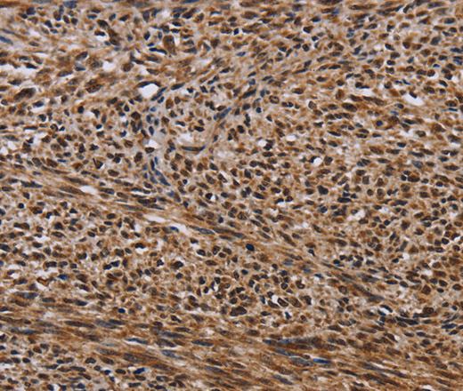 Immunohistochemistry of paraffin-embedded Human sarcoma using KIF1C Polyclonal Antibody at dilution of 1:60