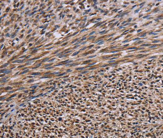 Immunohistochemistry of paraffin-embedded Human sarcoma tissue using KIF2A Polyclonal Antibody at dilution 1:30