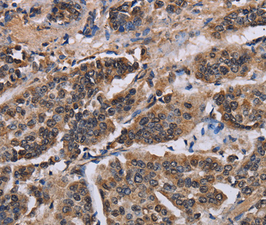 Immunohistochemistry of paraffin-embedded Human breast cancer tissue using KIF2A Polyclonal Antibody at dilution 1:30