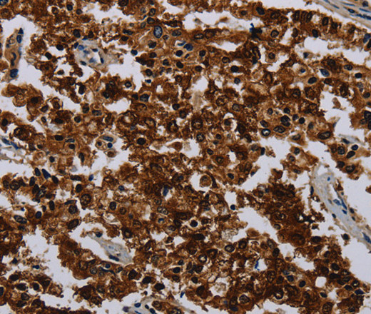 Immunohistochemistry of paraffin-embedded Human liver cancer tissue using KLK11 Polyclonal Antibody at dilution 1:50