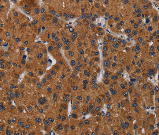 Immunohistochemistry of paraffin-embedded Human liver cancer tissue using KLK8 Polyclonal Antibody at dilution 1:50