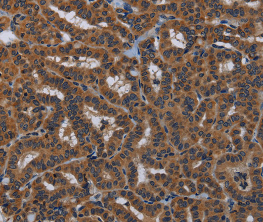 Immunohistochemistry of paraffin-embedded Human thyroid cancer tissue using KLK8 Polyclonal Antibody at dilution 1:50