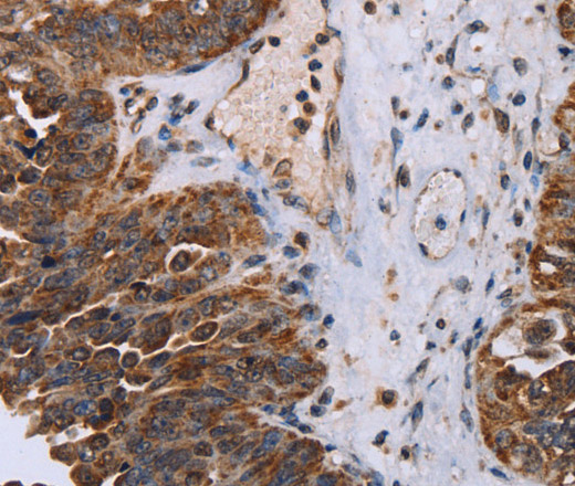 Immunohistochemistry of paraffin-embedded Human ovarian cancer tissue using DDX11 Polyclonal Antibody at dilution 1:30