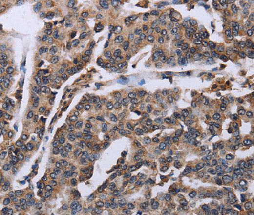 Immunohistochemistry of paraffin-embedded Human breast cancer tissue using DDX11 Polyclonal Antibody at dilution 1:30