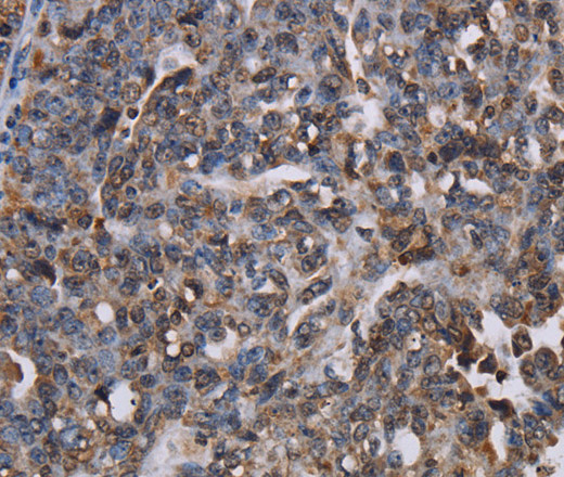 Immunohistochemistry of paraffin-embedded Human ovarian cancer using LBR Polyclonal Antibody at dilution of 1:50