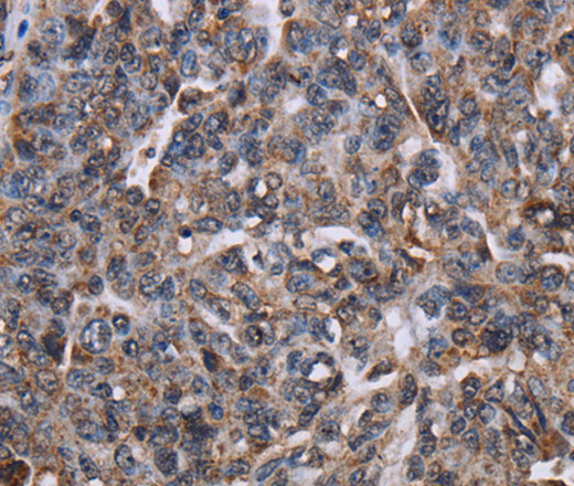 Immunohistochemistry of paraffin-embedded Human ovarian cancer tissue using LDOC1 Polyclonal Antibody at dilution 1:50