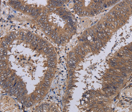 Immunohistochemistry of paraffin-embedded Human colon cancer tissue using P3H3 Polyclonal Antibody at dilution 1:40