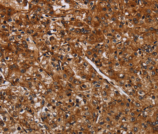 Immunohistochemistry of paraffin-embedded Human prostate cancer using ACP6 Polyclonal Antibody at dilution of 1:30