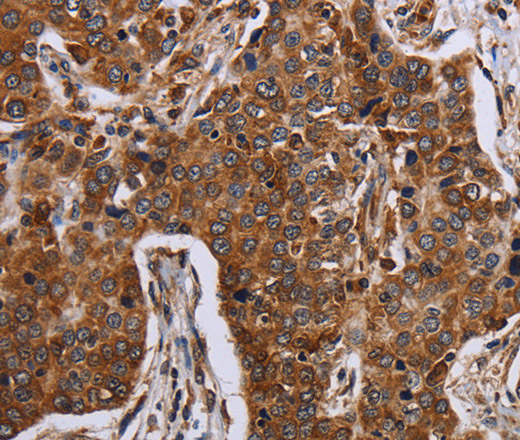 Immunohistochemistry of paraffin-embedded Human liver cancer using ACP6 Polyclonal Antibody at dilution of 1:30