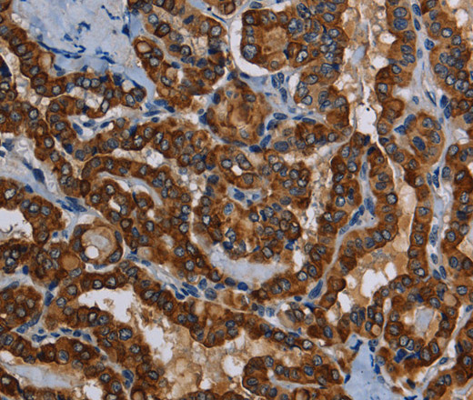 Immunohistochemistry of paraffin-embedded Human thyroid cancer tissue using PIDD1 Polyclonal Antibody at dilution 1:50