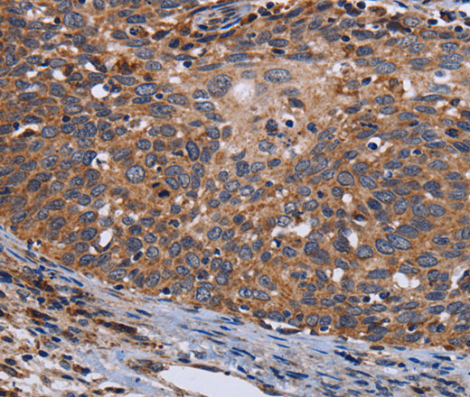 Immunohistochemistry of paraffin-embedded Human cervical cancer tissue using LRRC15 Polyclonal Antibody at dilution 1:60