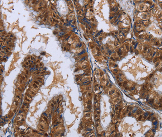 Immunohistochemistry of paraffin-embedded Human esophagus cancer using LTA4H Polyclonal Antibody at dilution of 1:30