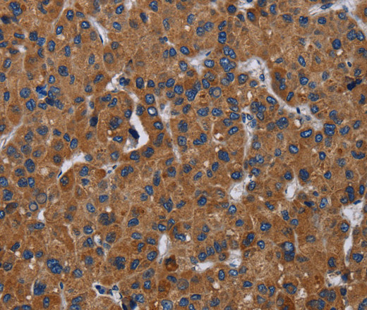 Immunohistochemistry of paraffin-embedded Human liver cancer using LZTFL1 Polyclonal Antibody at dilution of 1:30