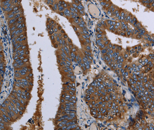 Immunohistochemistry of paraffin-embedded Human colon cancer using LZTFL1 Polyclonal Antibody at dilution of 1:30