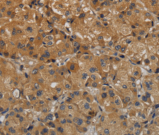 Immunohistochemistry of paraffin-embedded Human liver cancer tissue using TAB1 Polyclonal Antibody at dilution 1:40