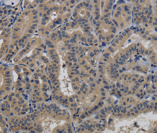 Immunohistochemistry of paraffin-embedded Human thyroid cancer tissue using TAB1 Polyclonal Antibody at dilution 1:40