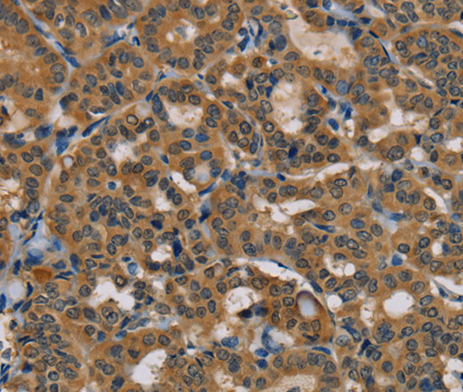 Immunohistochemistry of paraffin-embedded Human thyroid cancer using TAB3 Polyclonal Antibody at dilution of 1:35