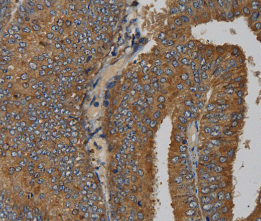 Immunohistochemistry of paraffin-embedded Human colon cancer tissue using MAS1 Polyclonal Antibody at dilution 1:50