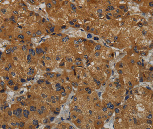 Immunohistochemistry of paraffin-embedded Human liver cancer tissue using MAS1 Polyclonal Antibody at dilution 1:50