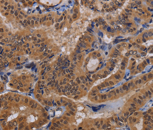 Immunohistochemistry of paraffin-embedded Human thyroid cancer using MCTS1 Polyclonal Antibody at dilution of 1:60