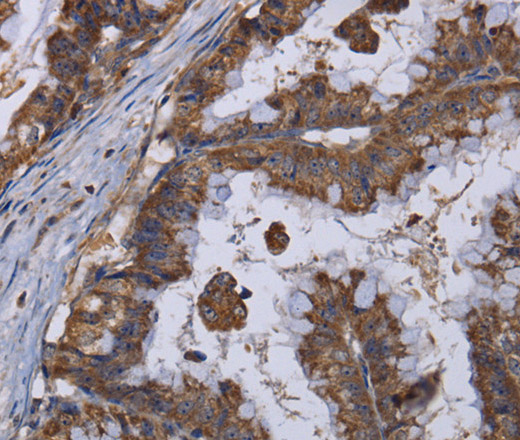 Immunohistochemistry of paraffin-embedded Human esophagus cancer tissue using MT3 Polyclonal Antibody at dilution 1:50