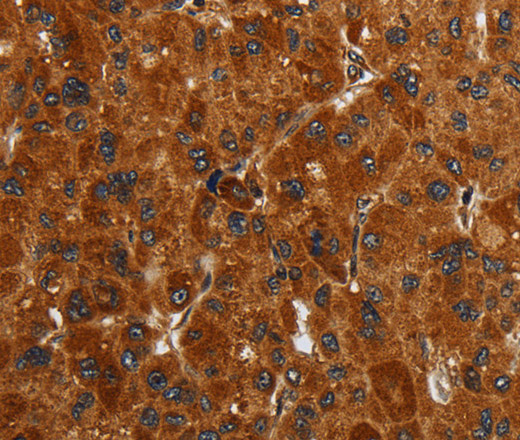 Immunohistochemistry of paraffin-embedded Human liver cancer tissue using ENTPD7 Polyclonal Antibody at dilution 1:40