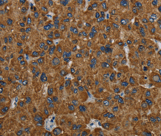 Immunohistochemistry of paraffin-embedded Human liver cancer using PCK2 Polyclonal Antibody at dilution of 1:60