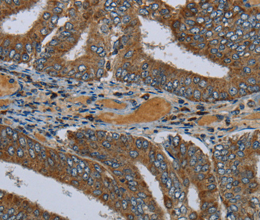 Immunohistochemistry of paraffin-embedded Human colon cancer using PCK2 Polyclonal Antibody at dilution of 1:60