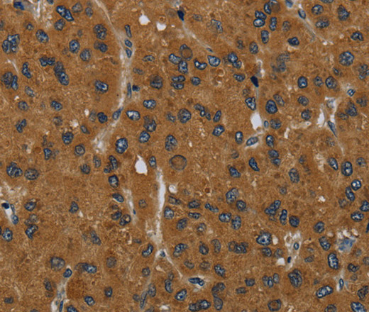 Immunohistochemistry of paraffin-embedded Human liver cancer tissue using MIER2 Polyclonal Antibody at dilution 1:60