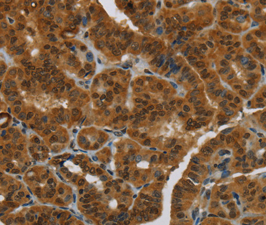 Immunohistochemistry of paraffin-embedded Human thyroid cancer tissue using MRE11 Polyclonal Antibody at dilution 1:60