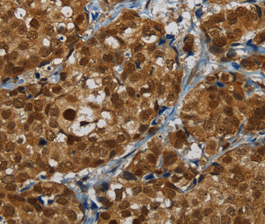 Immunohistochemistry of paraffin-embedded Human breast cancer tissue using MRE11 Polyclonal Antibody at dilution 1:60