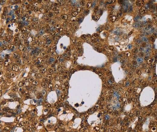 Immunohistochemistry of paraffin-embedded Human cervical cancer using PSMC2 Polyclonal Antibody at dilution of 1:30