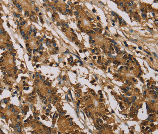 Immunohistochemistry of paraffin-embedded Human colon cancer using PSMC2 Polyclonal Antibody at dilution of 1:30