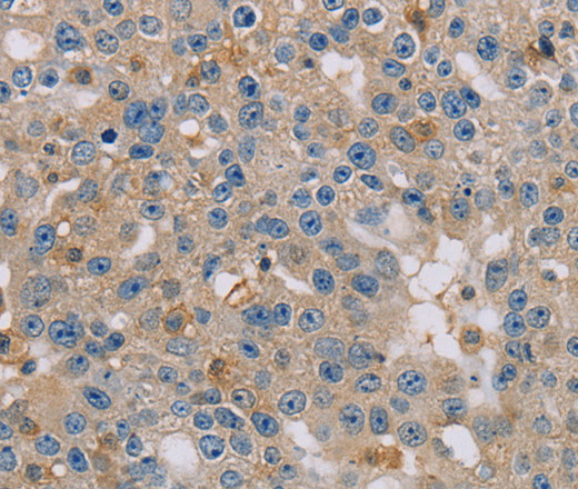 Immunohistochemistry of paraffin-embedded Human breast cancer using CLIC1 Polyclonal Antibody at dilution of 1:30