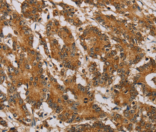 Immunohistochemistry of paraffin-embedded Human colon cancer using NDUFA10 Polyclonal Antibody at dilution of 1:40