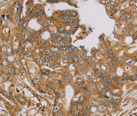 Immunohistochemistry of paraffin-embedded Human cervical cancer using NDUFA10 Polyclonal Antibody at dilution of 1:40