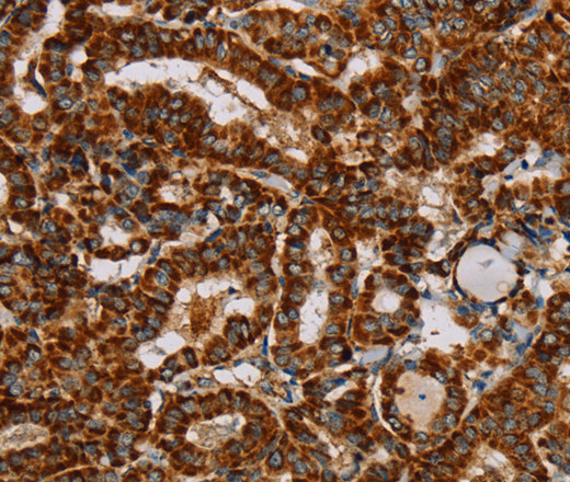 Immunohistochemistry of paraffin-embedded Human thyroid cancer using NDUFS3 Polyclonal Antibody at dilution of 1:40