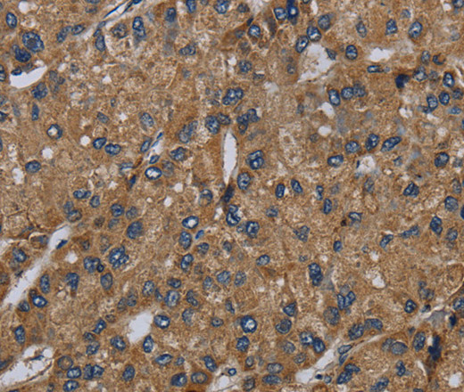 Immunohistochemistry of paraffin-embedded Human liver cancer tissue using NDUFS6 Polyclonal Antibody at dilution 1:50