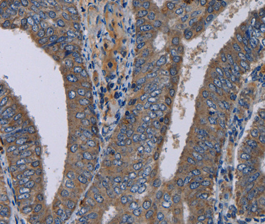 Immunohistochemistry of paraffin-embedded Human colon cancer tissue using NECTIN4 Polyclonal Antibody at dilution of 1:40